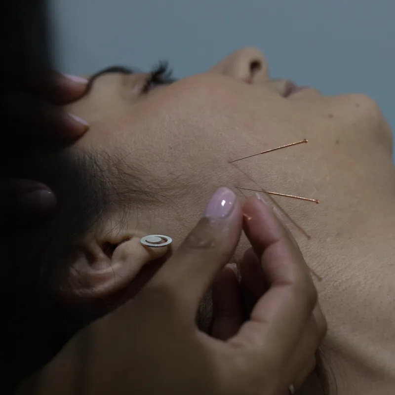 Performing facial acupuncture treatment